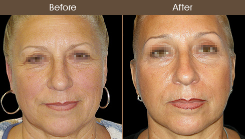 Before & After Facelift Treatment