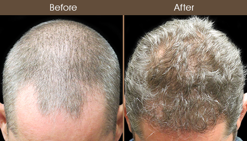 Before And After Hair Restoration