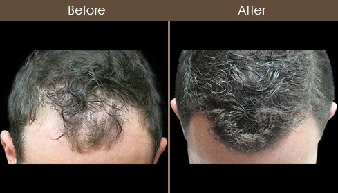 Hair Restoration Treatment Results