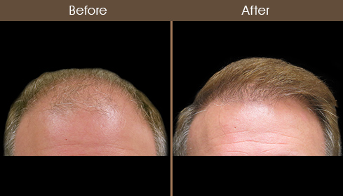 Hair Restoration Treatment Before & After