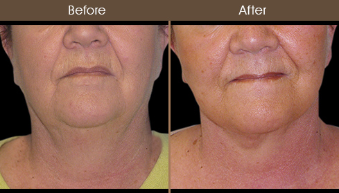 Necklift Surgery Before & After