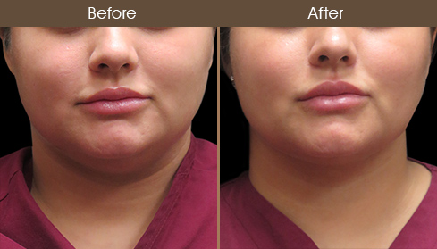 Scarless Face Lift Before & After