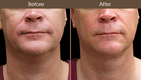 Scarless Neck Lift Before And After
