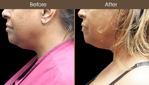 Scarless Neck Lift Surgery Results