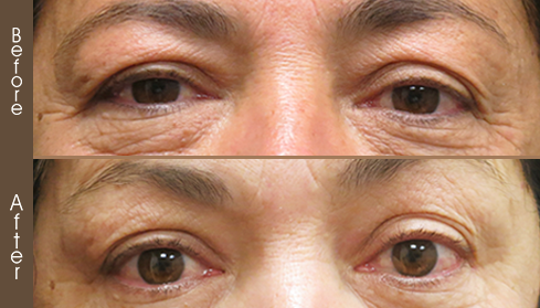 Before And After Blepharoplasty Surgery