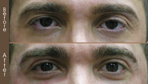 Before And After Blepharoplasty Surgery In NYC