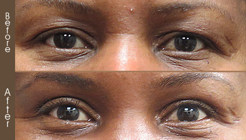 Before And After Eyelid Surgery In NY