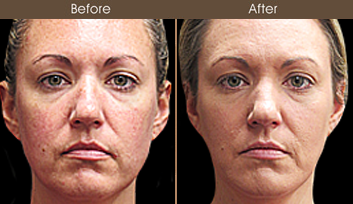 Scarless Face Lift Surgery Results