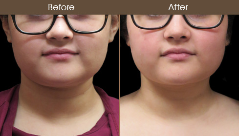 Before & After Scarless Neck Lift Surgery