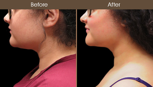 Scarless Necklift Before And After