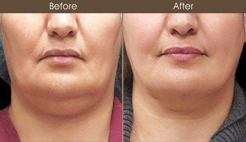 Scarless Facelift Before And After