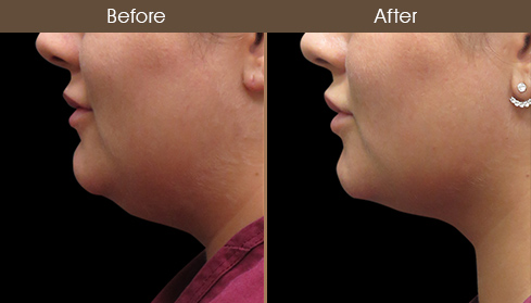 Laser Necklift Surgery Before & After