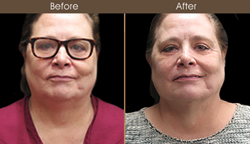 Laser Necklift Before And After In NYC