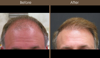 Hair Restoration Before And After