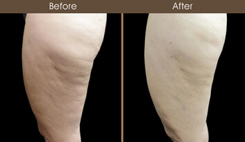 Cellulaze Before And After