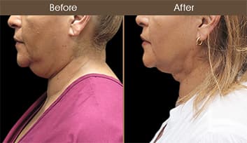Scarless Facelift / Laser Neck Lift Before And After