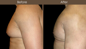 Male Breast Reduction Before And After Side View