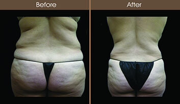 Vaser LipoSelection Before And After