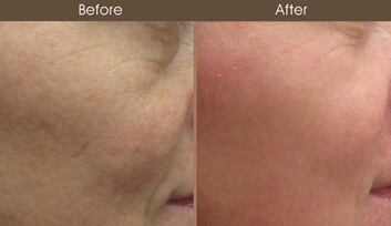 Laser Skin Resurfacing Before And After