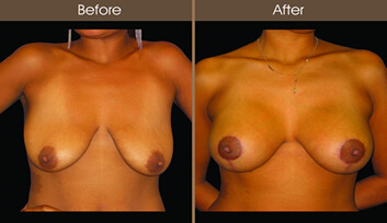 Breast Lift Before And After Front Image