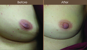 Inverted Nipple Surgery Before And After