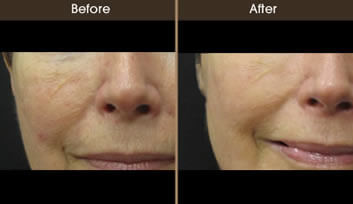 Rosacea Treatment Before And After