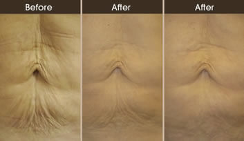 Skin Tightening Before And After
