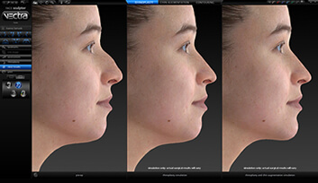 Vectra 3D Aesthetic Simulation Before And After
