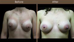 Breast Reconstruction Before And After Front Image
