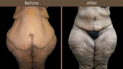 Lower Body Lift Surgery Before And After Front View