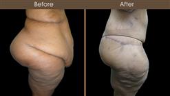 Lower Body Lift Surgery Before And After Right Side View