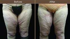 Thigh Lift Surgery Before And After Front Image