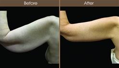 Arm Lift Surgery Before And After