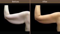 Brachioplasty Before And After Back Image