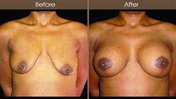 Mastopexy Before And After Front View