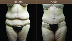 Post Bariatric Surgery Abdominoplasty Results