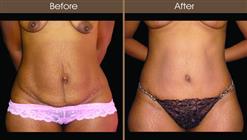 Mommy Makeover Tummy Tuck Before And After