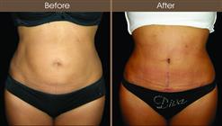 Mommy Makeover Tummy Tuck Before And After Front View