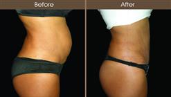 Mommy Makeover Tummy Tuck Before And After Right Side View