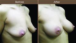 Mommy Makeover Procedure Before And After Right Side Image