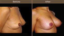 Breast Implant Before And After Right Quarter Image