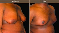 Male Breast Reduction Results