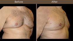 Gynecomastia Surgery Before And After Right Quarter View