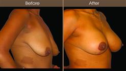 Breast Lift Results