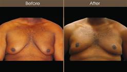 Male Breast Reduction Before And After Front Image