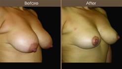 Breast Reduction Surgery Before And After Right Quarter Image