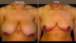 Breast Reduction Before And After
