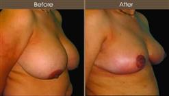 Breast Reduction Surgery Results