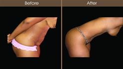 Tummy Tuck Before And After Right Side View