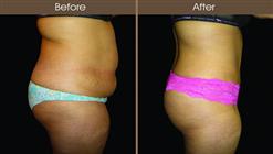 Abdominoplasty Before And After Right Side Image